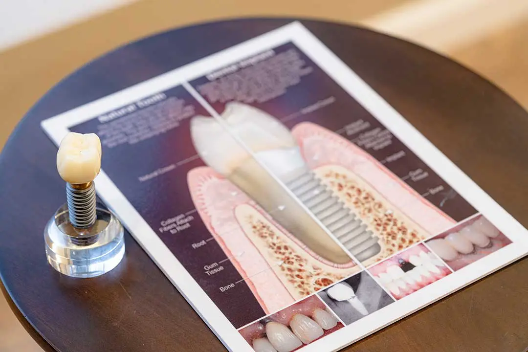 Dental Implants at Carabelli Dental, Orlando, Florida