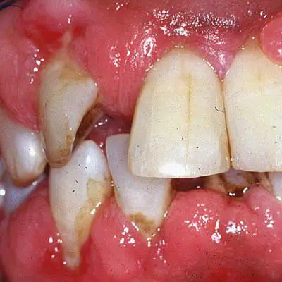 Extraction Reason: Advanced Gum Disease