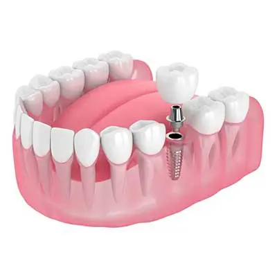 Dental Implants in Orlando, FL