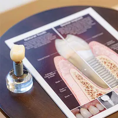 Dental Implants in Orlando, FL
